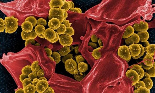 Staphylococcus aureus kao uzročnik bakterijskog prostatitisa