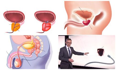 zdrave i bolesne prostate